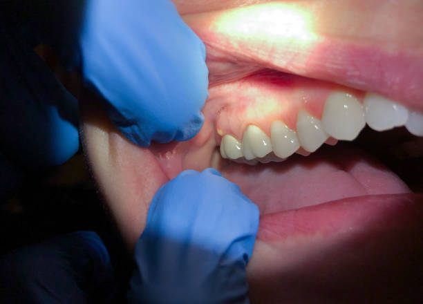 Best Tooth Infection Emergency Dentist  in Milbank, SD